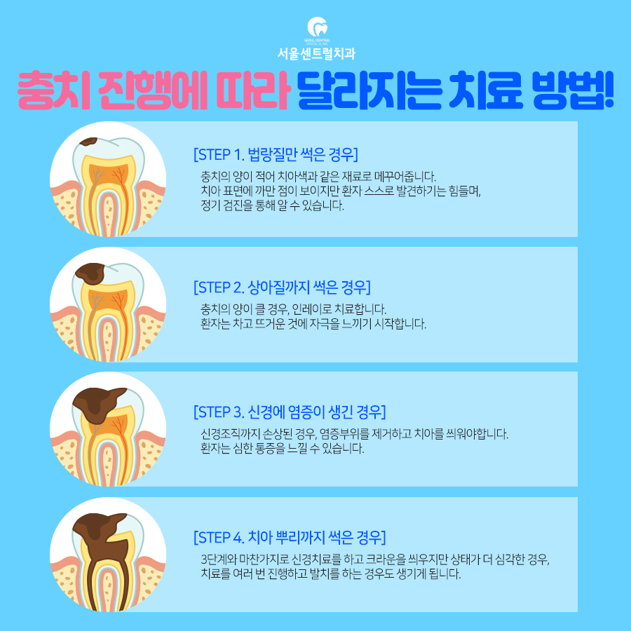 충치진행단계