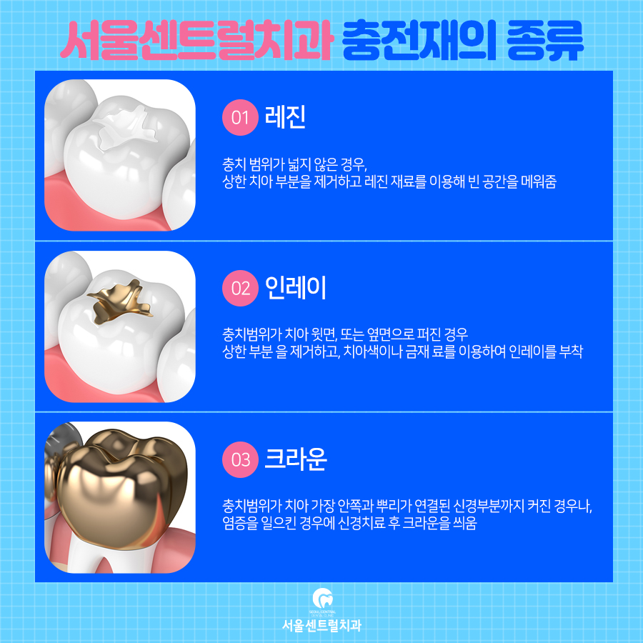 치아충전재