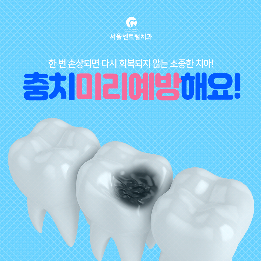 충치예방안내