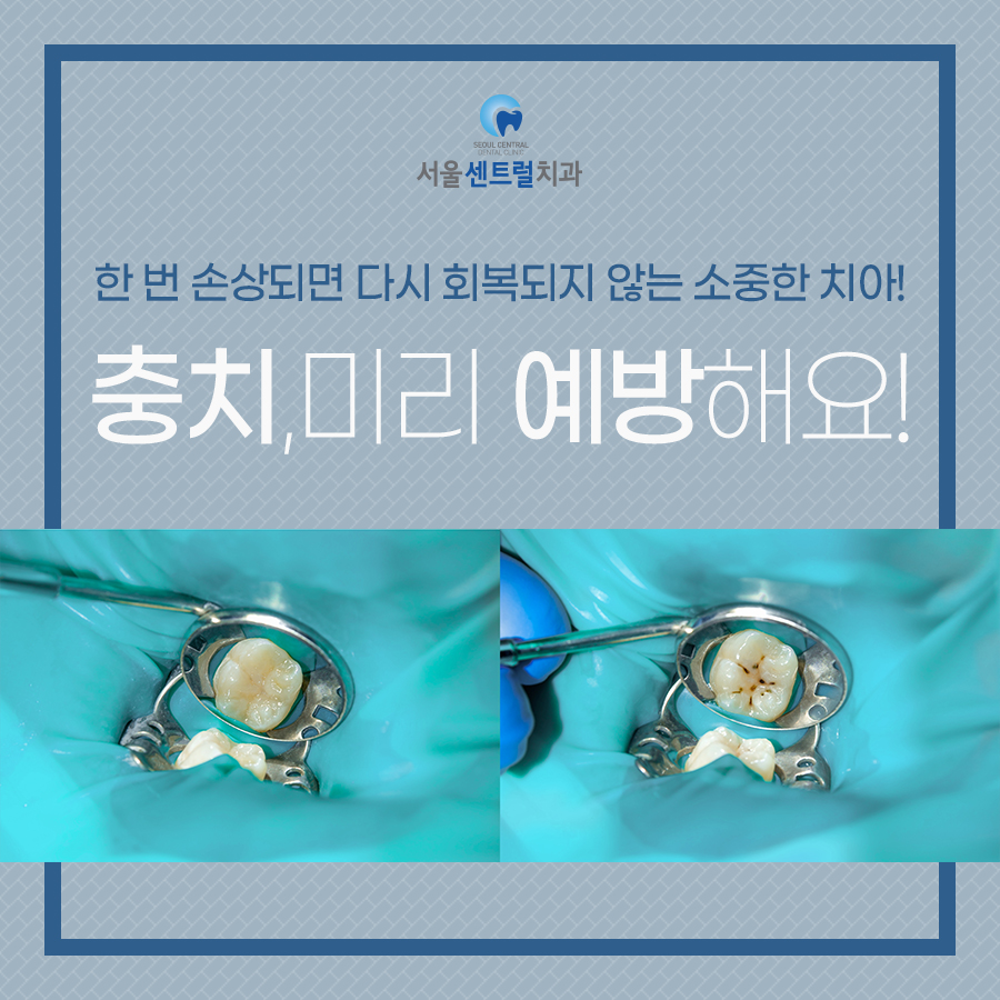 충치치료전후