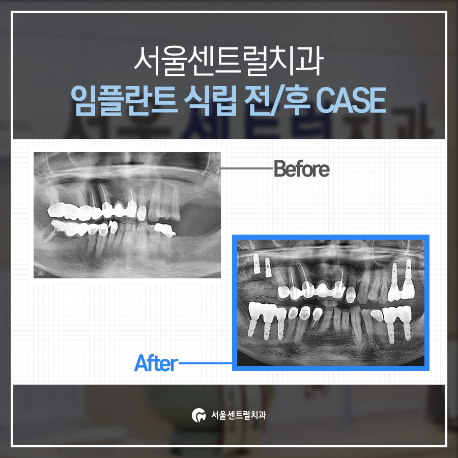 식립전후사례
