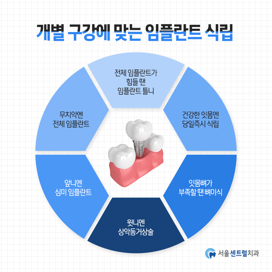 처인구임플란트, 진단부터 보철까지 몇 단계로 진행되나요? — 서울센트럴치과의원